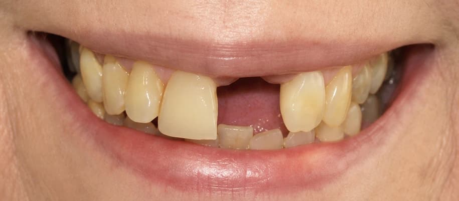Glimlach van een patiënt vóór een esthetische spoedreparatie op dezelfde dag bij Dentacare Osdorp.