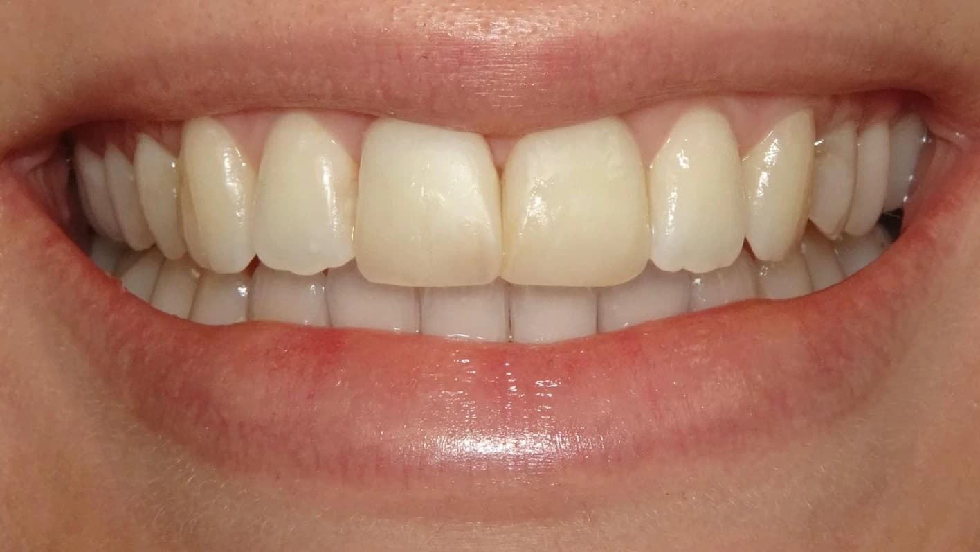 Porseleinen Veneers: Gebit van patiënt voor de behandeling bij Dentacare Osdorp.