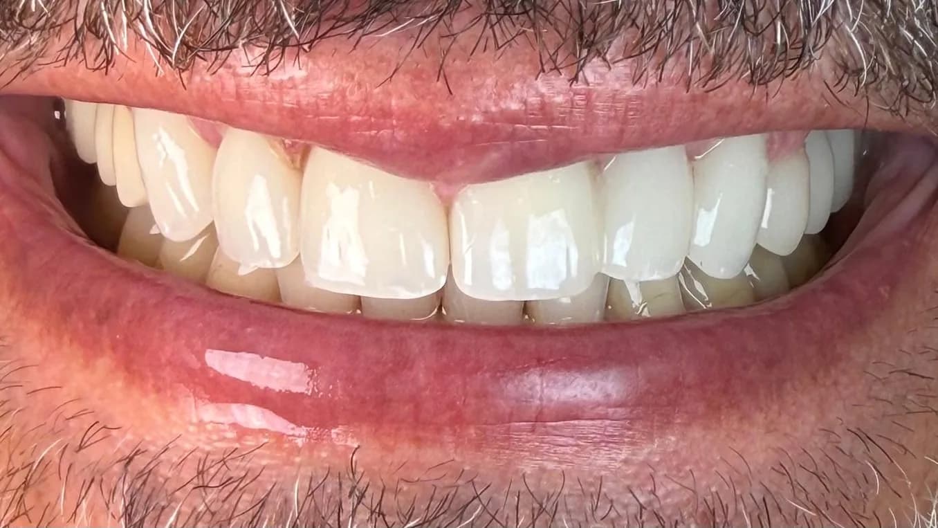 Kroonrestauratie: Glimlach van patiënt na de kroonbehandeling bij Dentacare Osdorp.