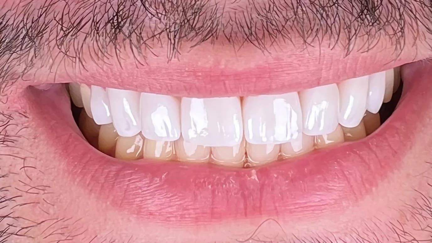 Porseleinen Veneers: Glimlach van patiënt na de behandeling bij Dentacare Osdorp.
