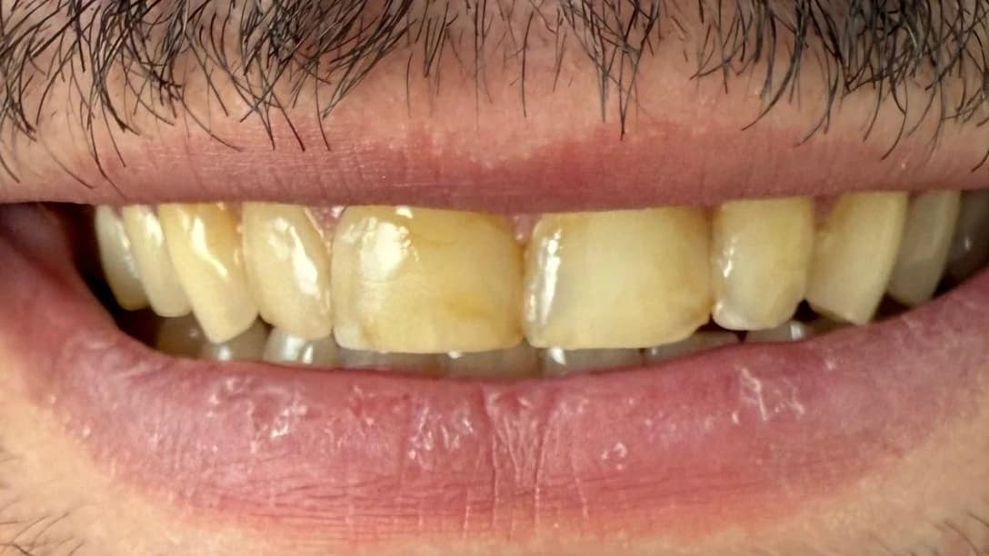 Porseleinen Veneers: Glimlach van patiënt voor de behandeling bij Dentacare Osdorp.