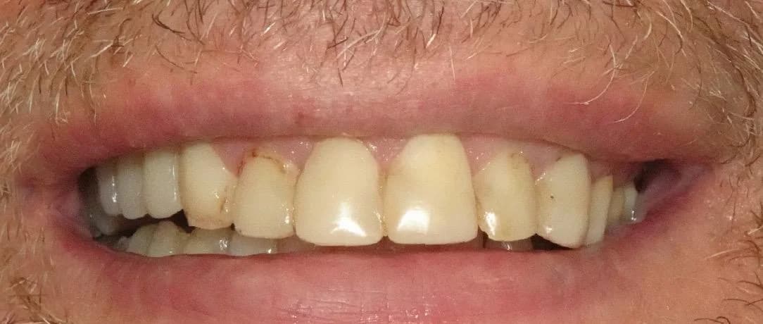 Porseleinen Veneers: Glimlach van patiënt voor de behandeling bij Dentacare Osdorp.
